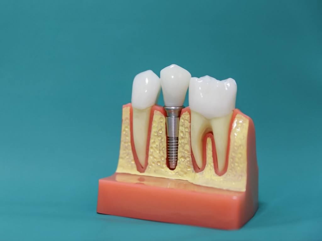 Implant obok zdrowych zębów
